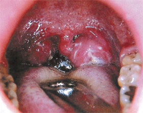 中咽頭癌の画像