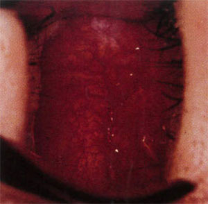 鼻出血の画像