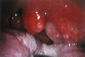 扁桃周囲膿瘍