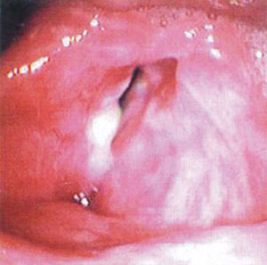 喉頭癌の画像2