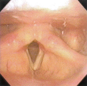 喉頭癌の画像