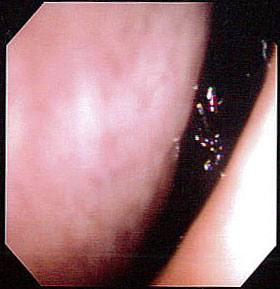 好酸球性副鼻腔炎の画像2