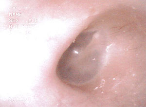 急性中耳炎　正常の画像