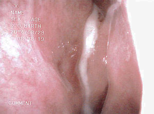 急性副鼻腔炎の画像