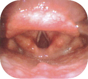 急性喉頭蓋炎　正常の画像