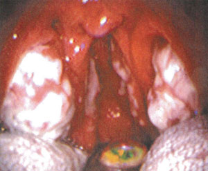 急性扁桃炎の画像2