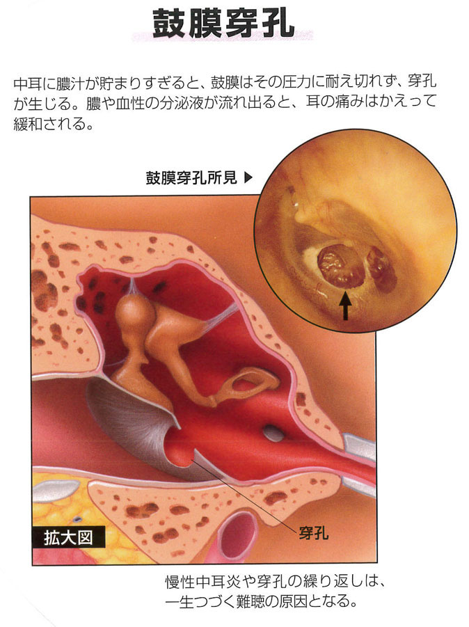慢性中耳炎-鼓膜穿孔