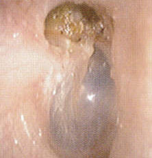 真珠腫中耳炎の画像